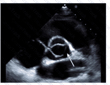 AE-Adult-Echocardiography Question 30