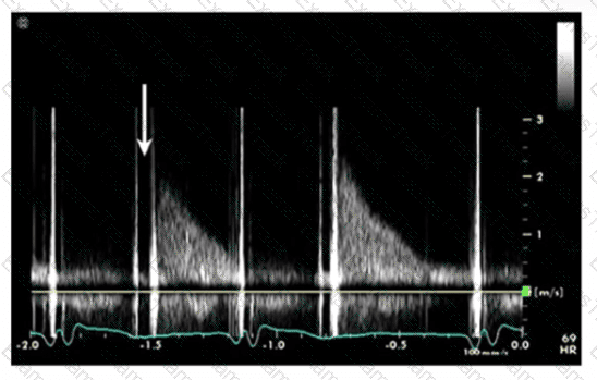 AE-Adult-Echocardiography Question 16